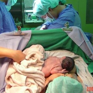 Dojčenie po cisárskom reze